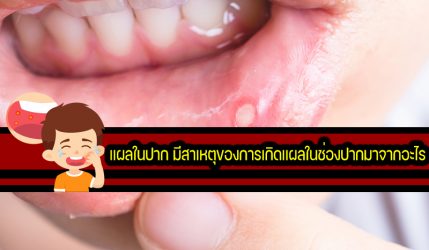 แผลในปาก มีสาเหตุของการเกิดแผลในช่องปากมาจากอะไร